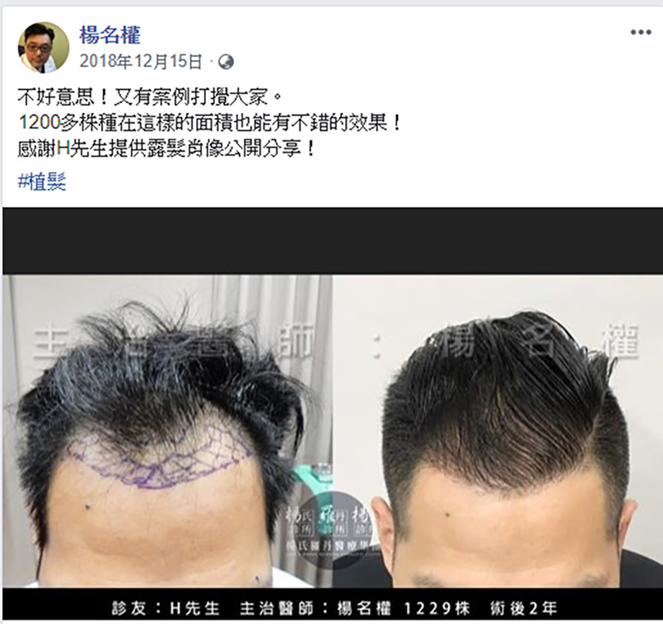 植髮,禿頭 掉髮 六合一三階段雄性禿治療,楊名權